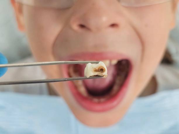 Best Emergency Dental Care for Broken or Chipped Teeth in Pen Mar, PA